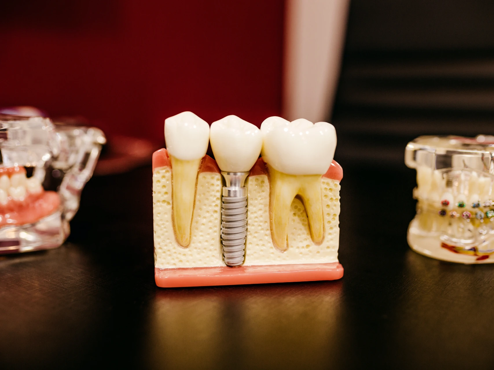 model of a single tooth dental implant | cost of dental implants in Colorado Springs, CO