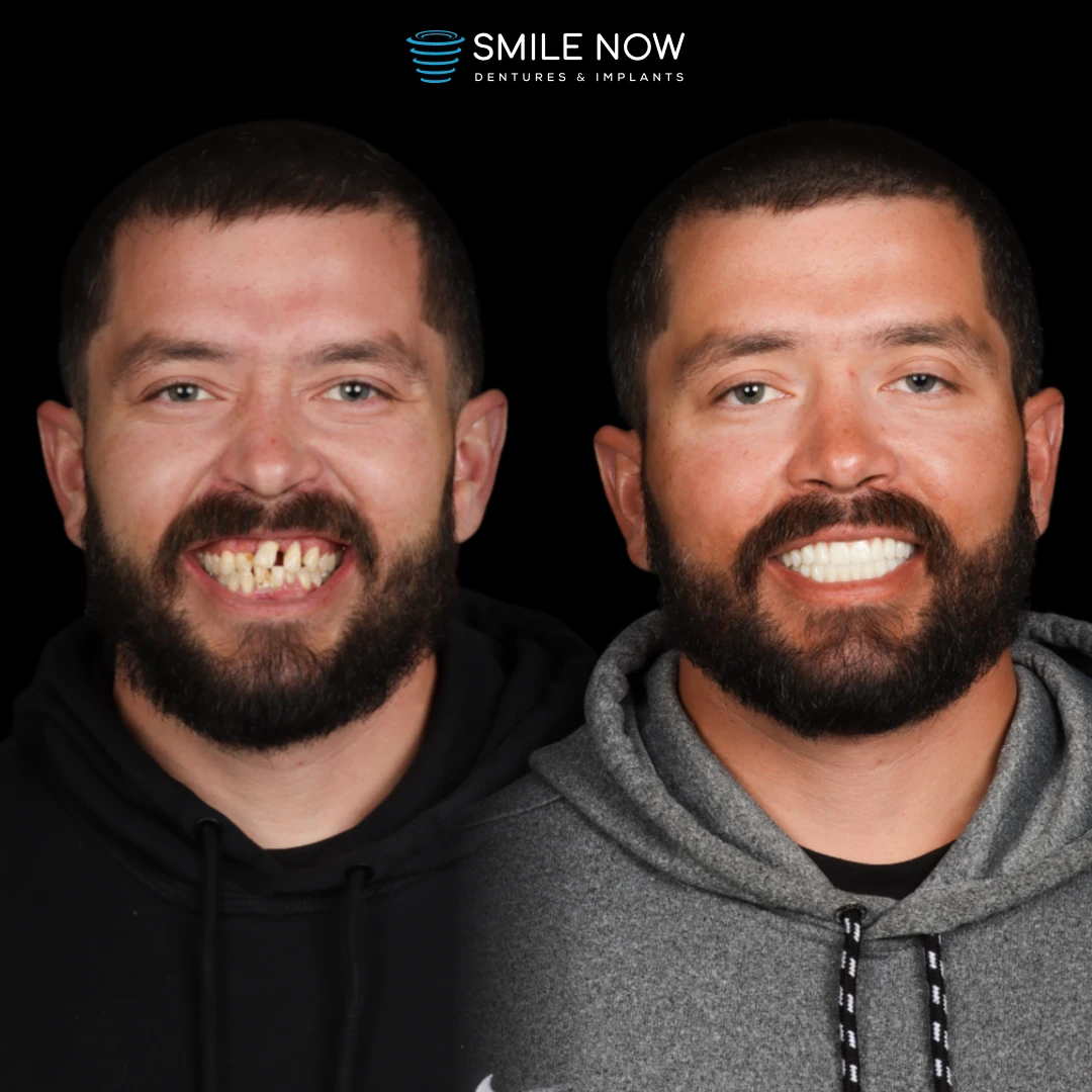 Patient smiling after a smooth All On 4 dental implant recovery