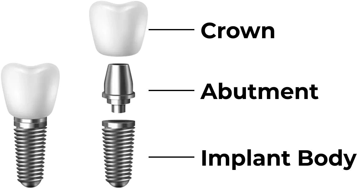 Diagram showing the parts of a dental implant to explain the single tooth implant cost without insurance