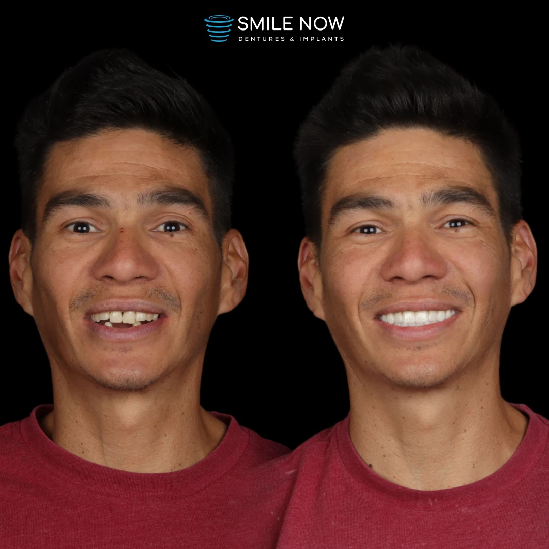 Patient smiling confidently after receiving same day dental implants