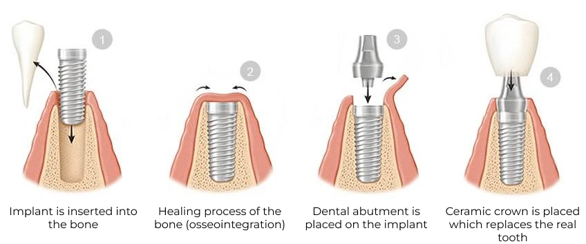 Diagram showing the dental implant process step by step from implant placement to final crown