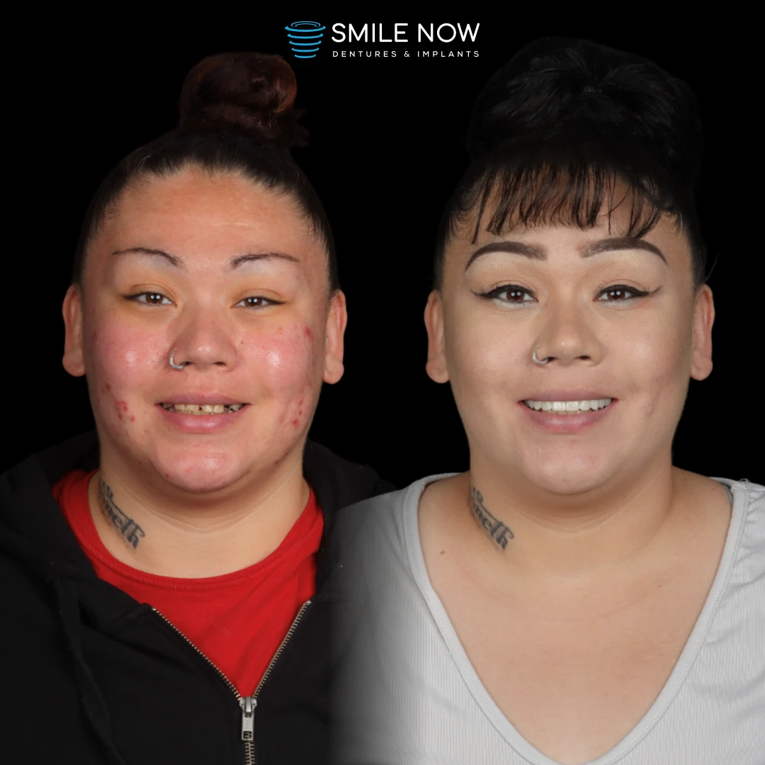 A detailed comparison image showing a tooth implant before and after a single tooth implant procedure.