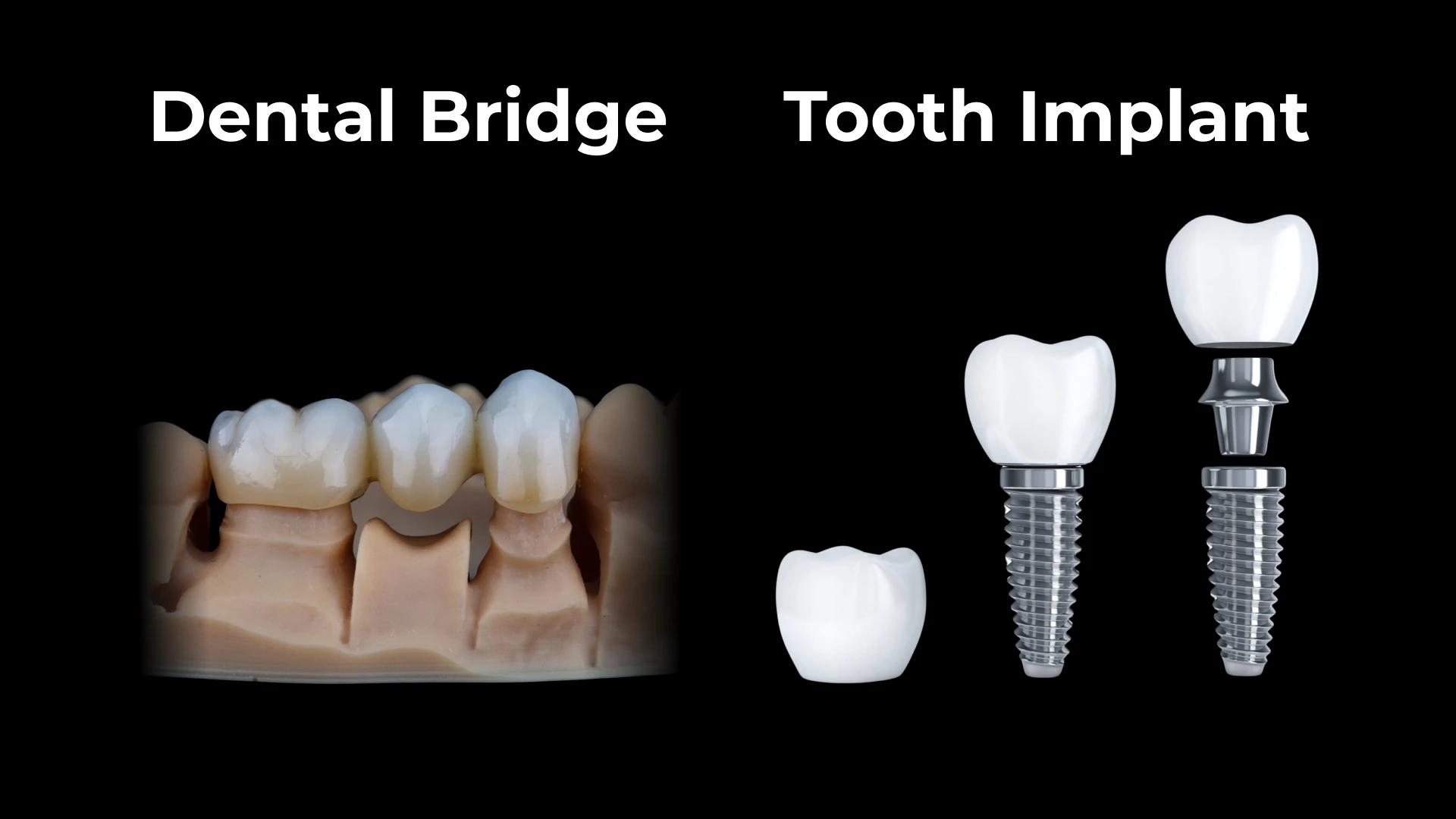 Graphic showing the structural differences in a dental bridge vs implant.