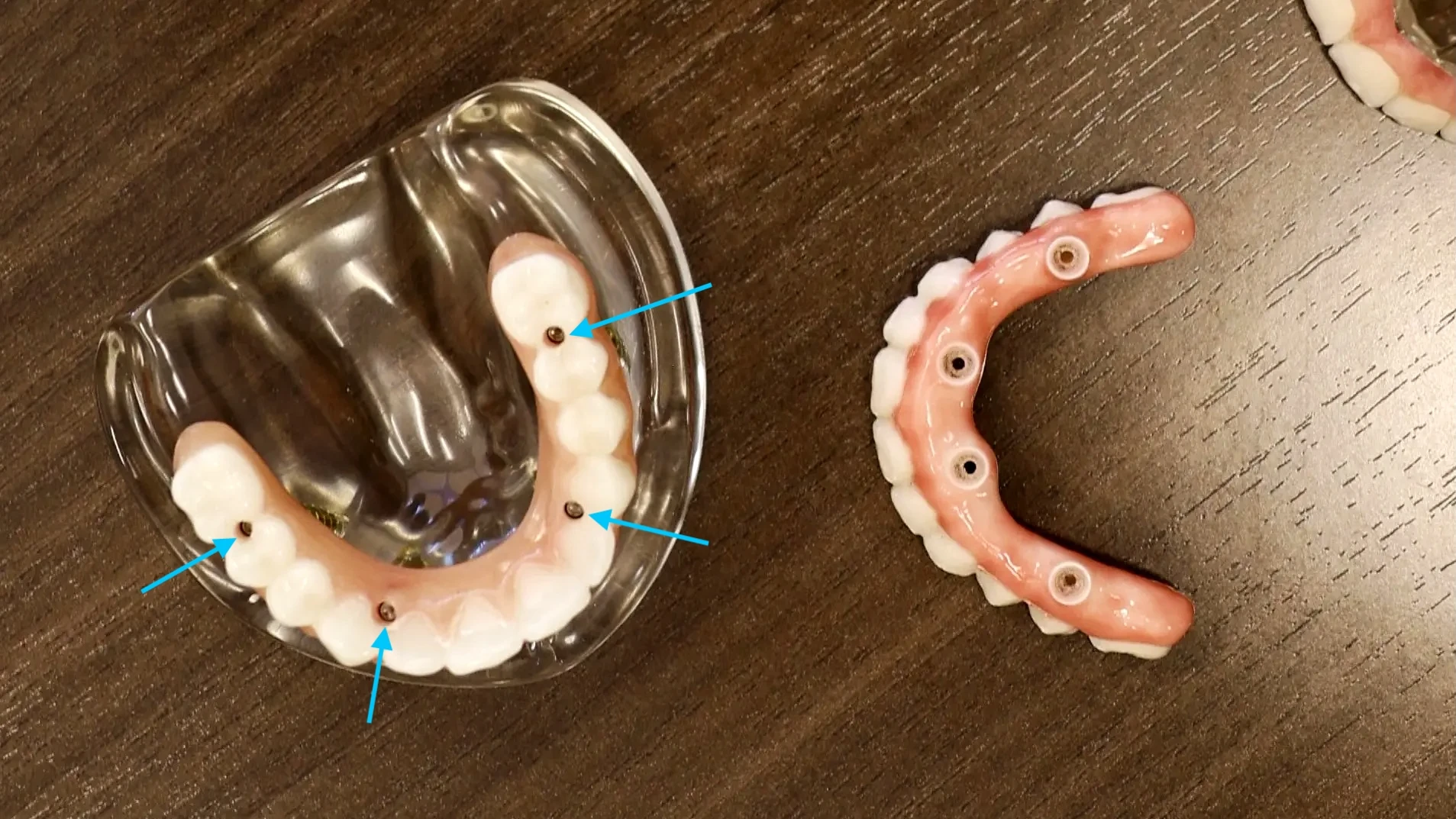 All on 4 dental implant models on desk with arrows pointing to screw hole access points for dental implant repair