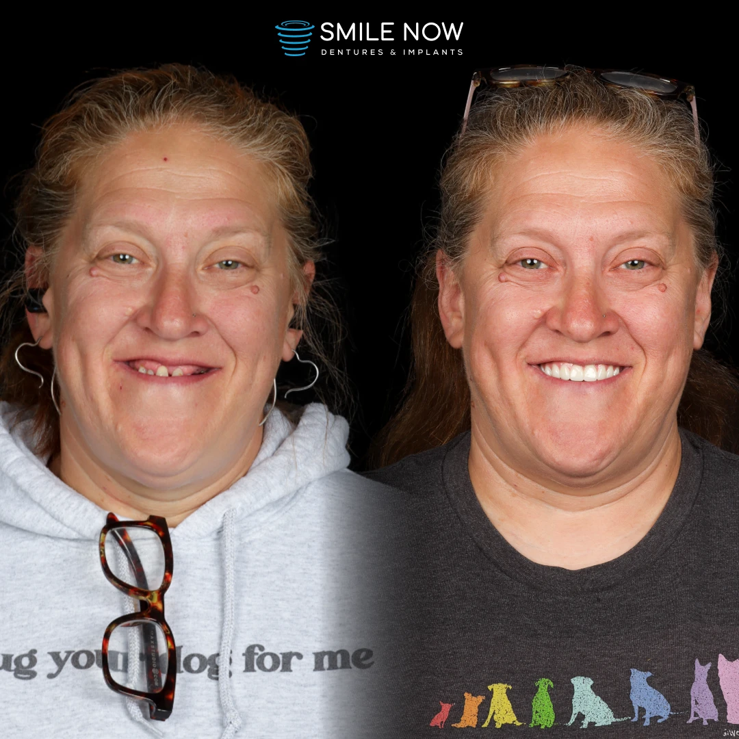 Patient smiling after successful recovery from dental implants