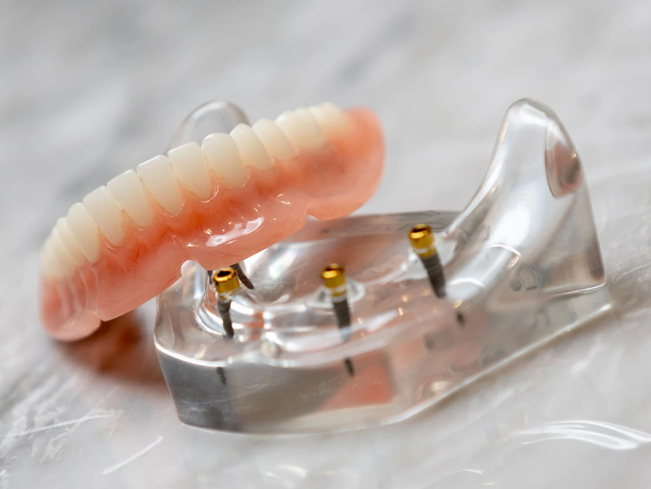 A photo of a lower snap in denture sitting on a table