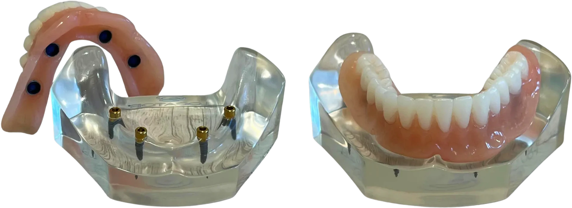Photos showing how snap in dentures attach to dental implants in the jaw.