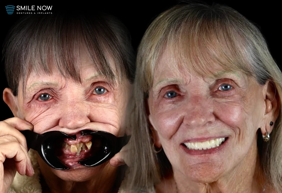 An older patient smiling before and after dental implants, illustrating the success of dental implants for seniors