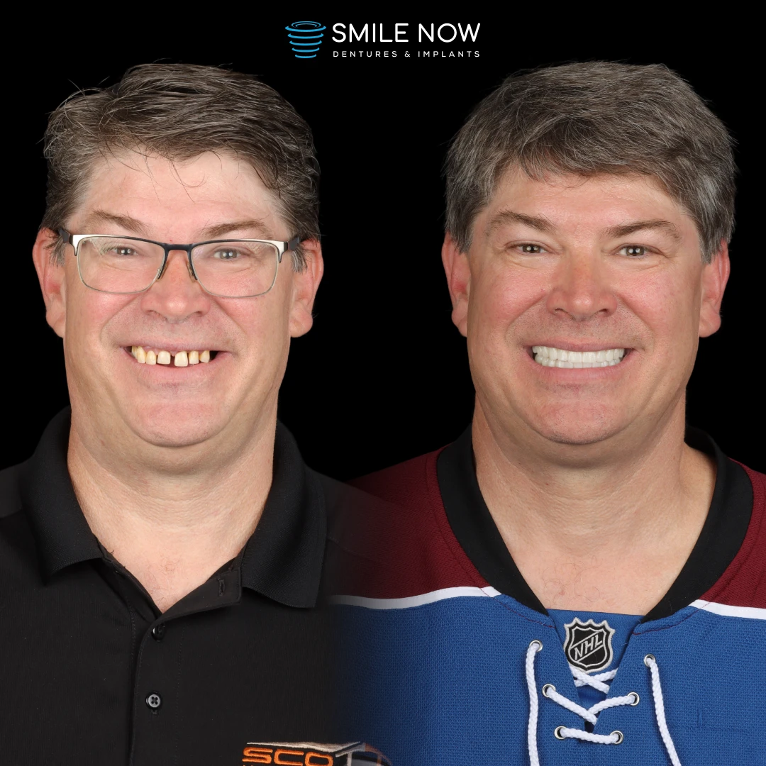 The dental implant timeline: Joey before and after dental implants.