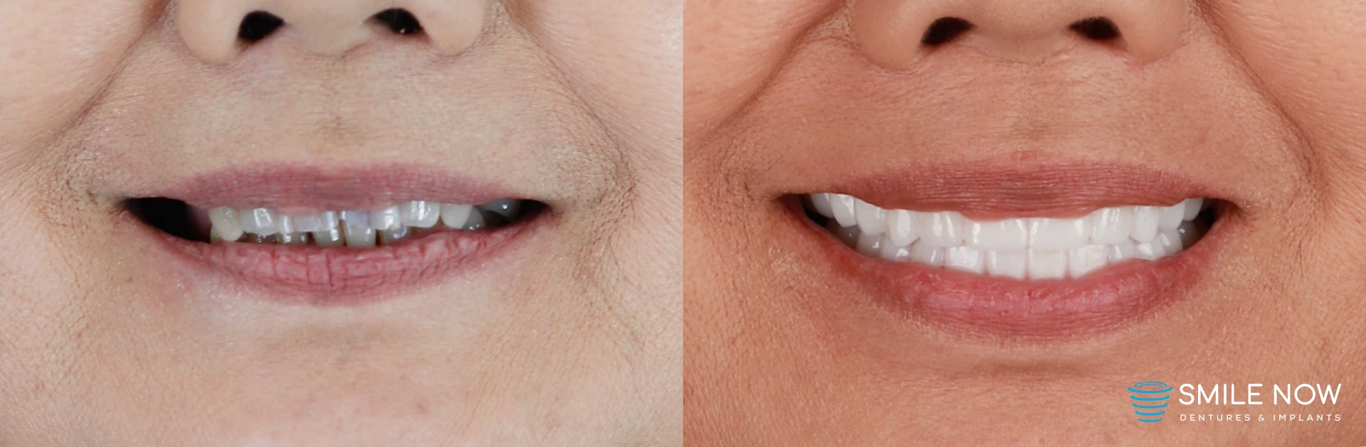 A patient smiling before and after all on 4 dental implants with zirconia final teeth